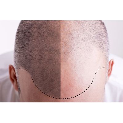 Terapia łysienia -  Dr.Cyj Hair Filler